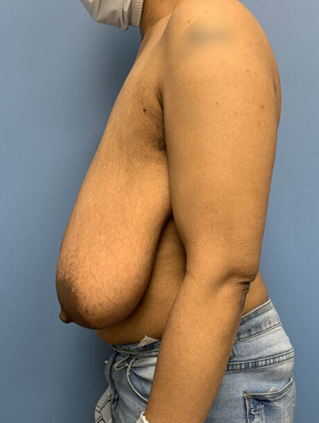 Breast Lift case #2712