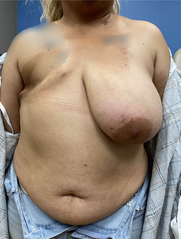 DIEP Flap case #2593