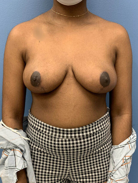 Breast Reduction case #2866