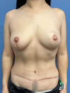 Nipple Reconstruction case #2997