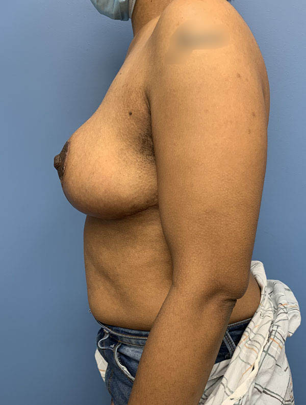 Breast Lift case #2712