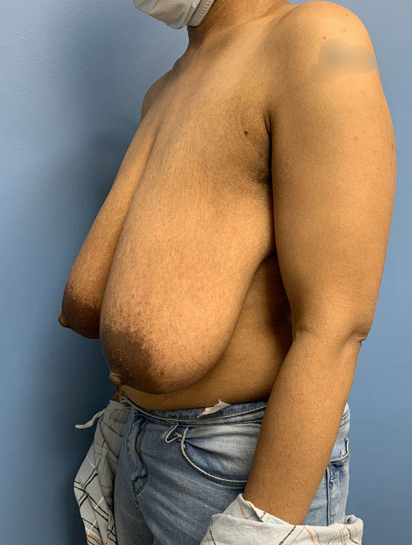 Breast Lift case #2712
