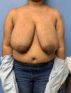 Breast Reduction case #2878