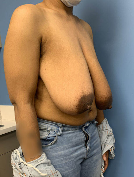 Breast Lift case #2712