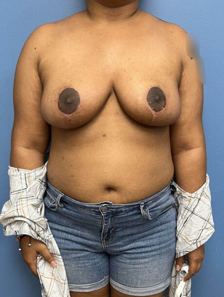 Breast Reduction case #2878