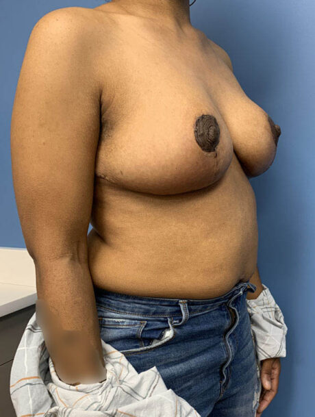 Breast Lift case #2712