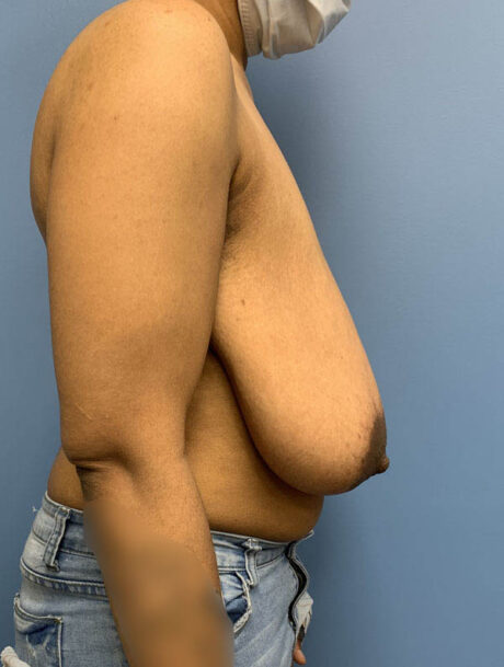 Breast Lift case #2712