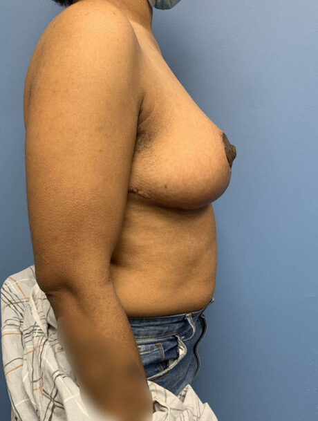 Breast Lift case #2712
