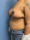 Breast Reduction case #2878