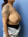 Breast Reduction case #2976