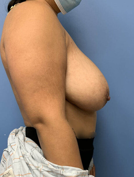 Breast Reduction case #2888