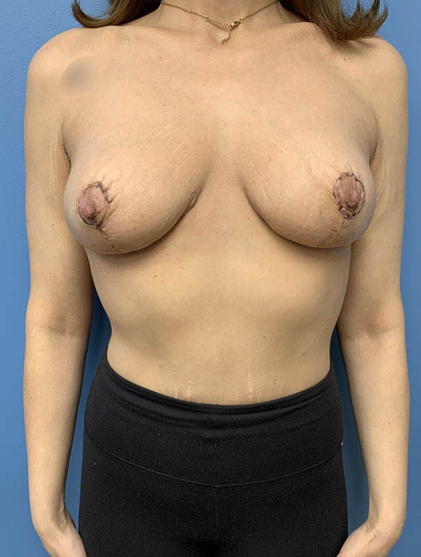 Breast Reduction case #2922