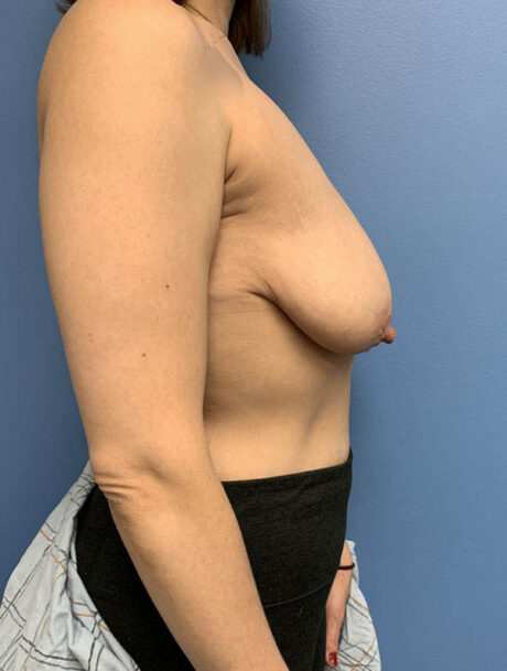 Breast Reduction case #2922