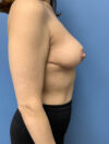Breast Reduction case #2922