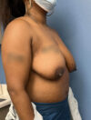 Breast Reduction case #2944