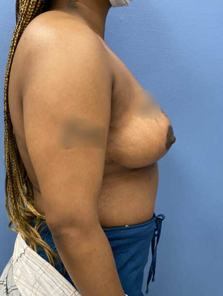 Breast Reduction case #2944