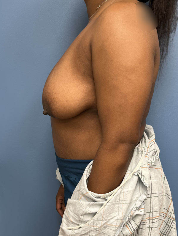 Breast Reduction case #2944