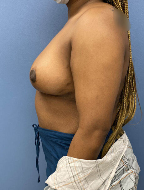 Breast Reduction case #2944