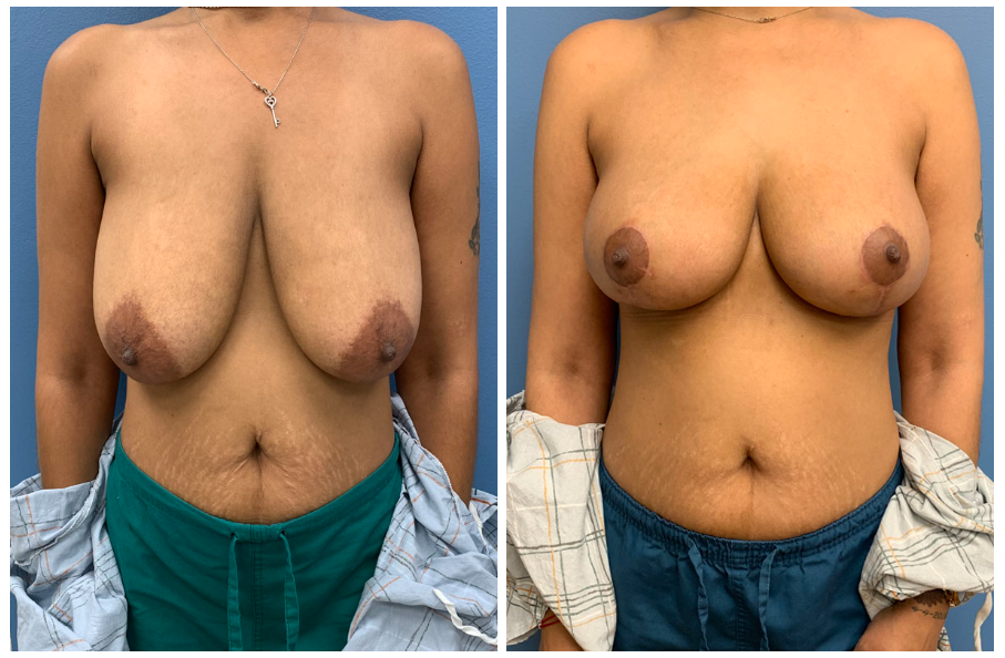 breastlift