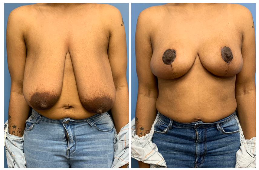 breastlift2