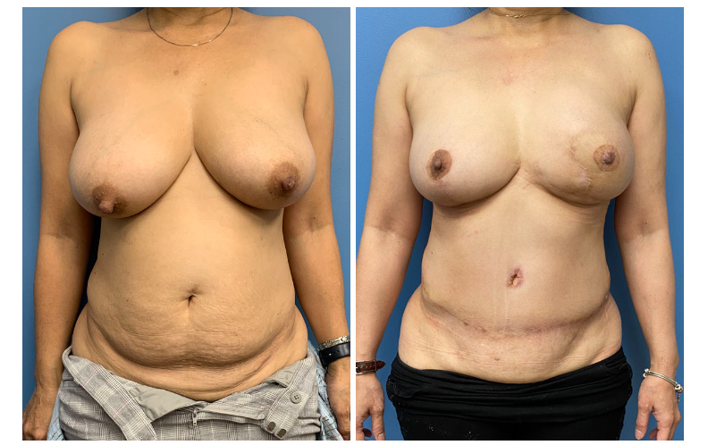 diep flap