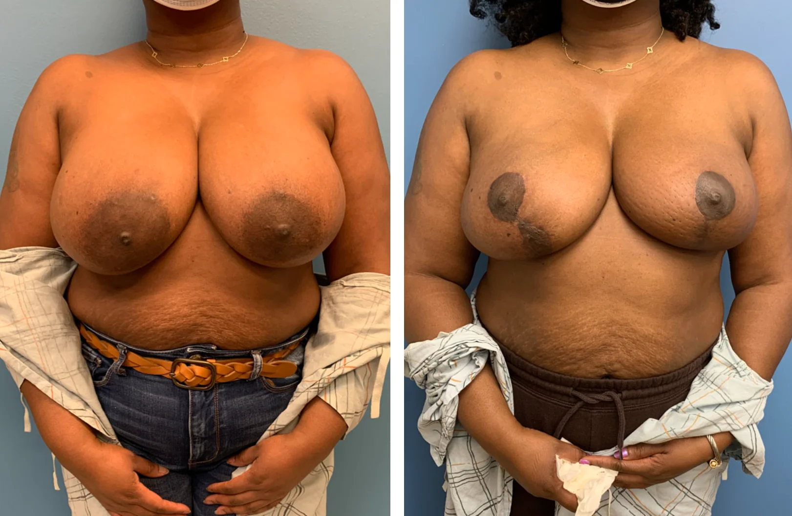 Real patient before and after case #1