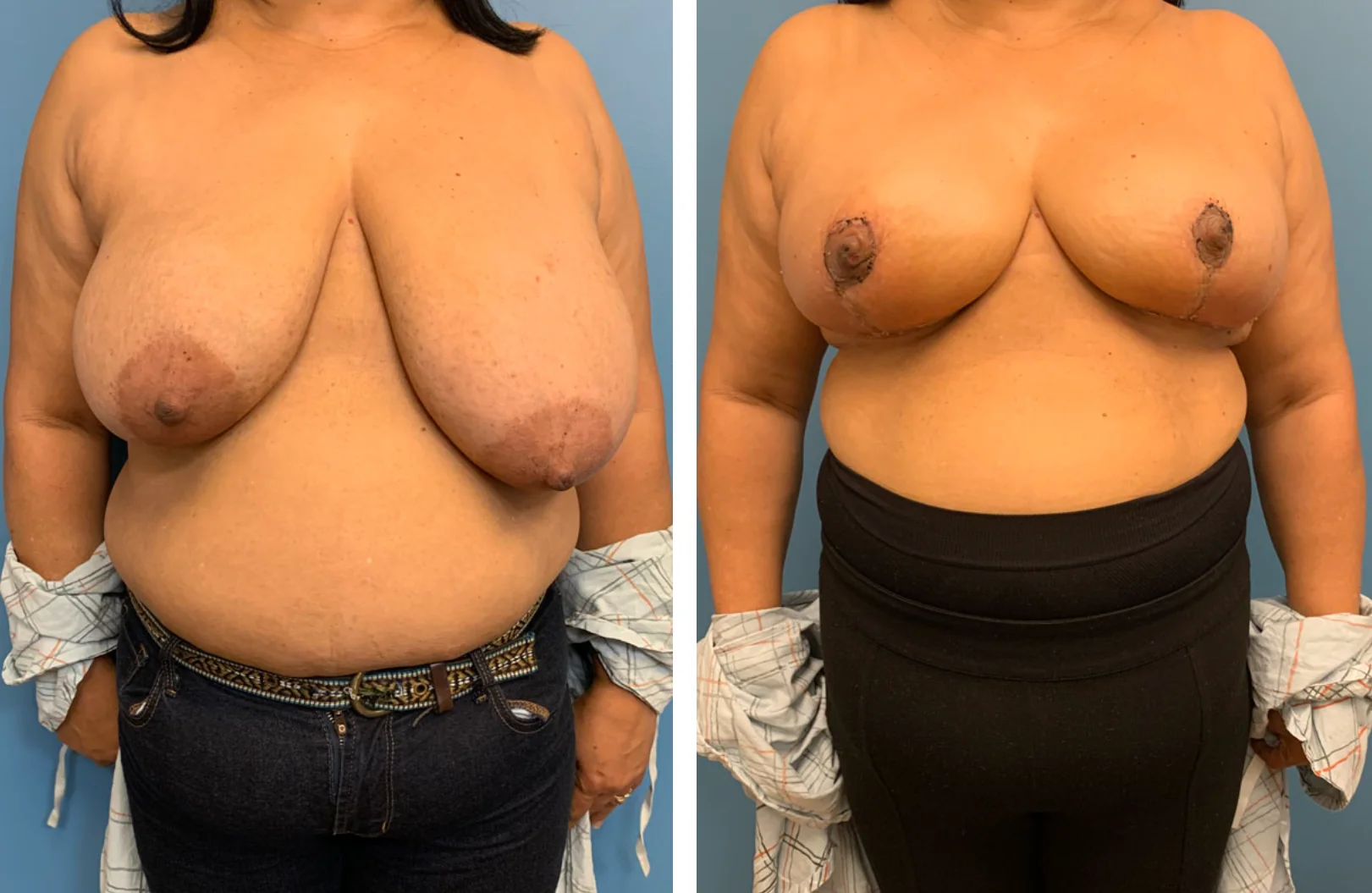 Real patient before and after case #2