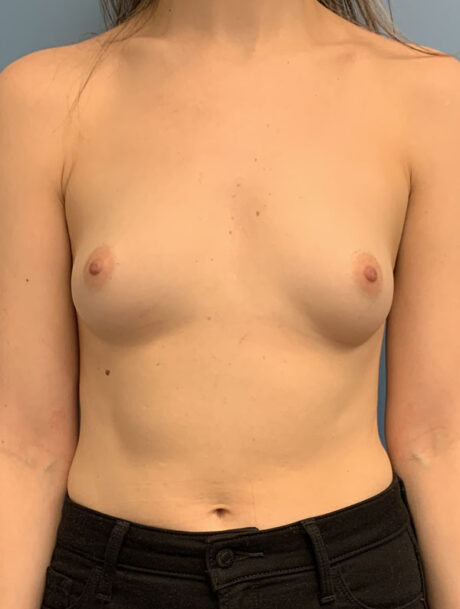Breast Augmentation case #2688