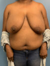Breast Reduction case #2724