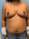 Breast Reduction case #2724
