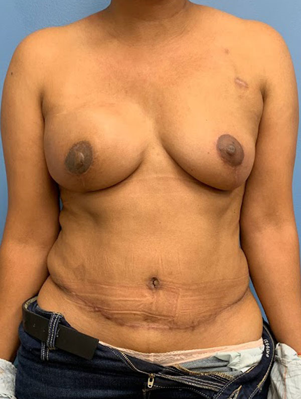 Nipple Reconstruction case #2995