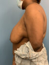 Breast Reduction case #2724