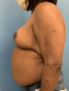Breast Reduction case #2724