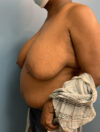 Breast Reduction case #2724