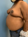 Breast Reduction case #2724