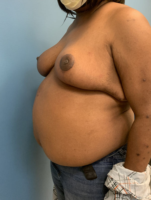 Breast Reduction case #2724