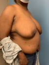 Breast Reduction case #2724