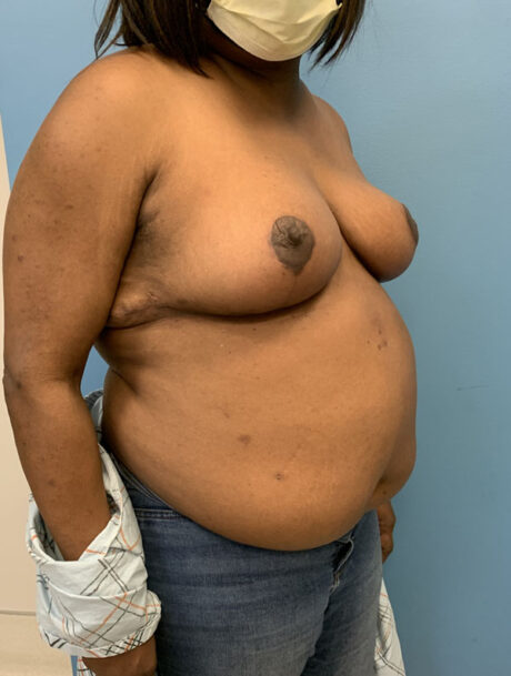 Breast Reduction case #2724