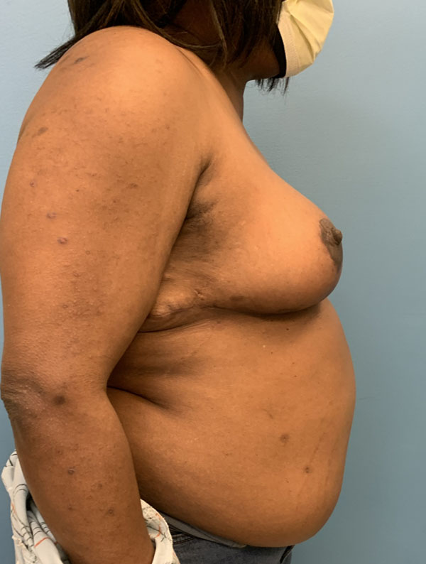 Breast Reduction case #2724