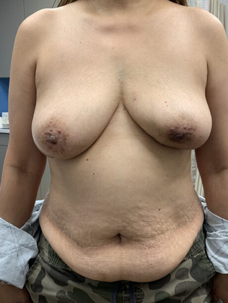 DIEP Flap case #2647