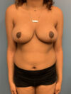 Breast Reduction case #2822