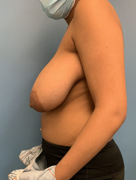 Breast Reduction case #2822