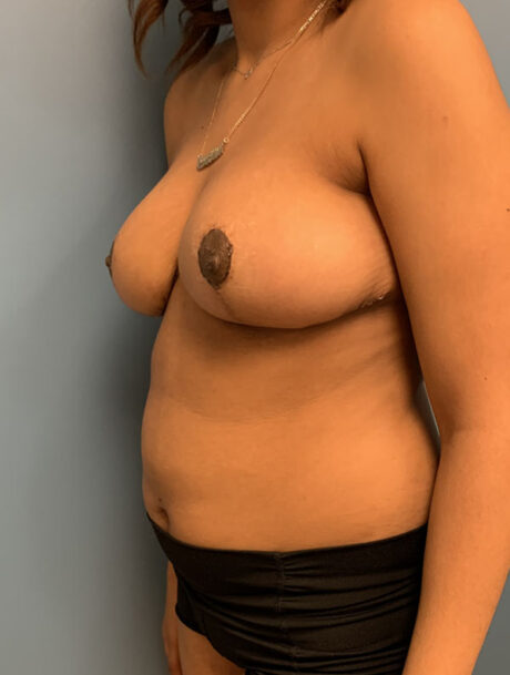 Breast Reduction case #2822