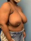 Breast Reduction case #2834