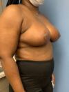 Breast Reduction case #2834