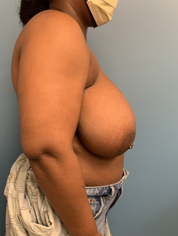 Breast Reduction case #2834