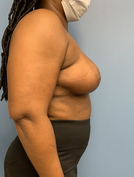 Breast Reduction case #2834
