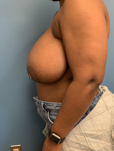 Breast Reduction case #2834