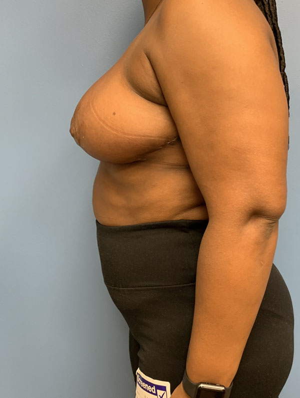 Breast Reduction case #2834