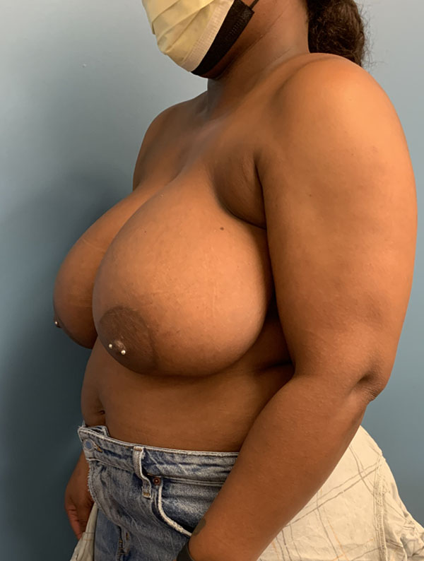 Breast Reduction case #2834
